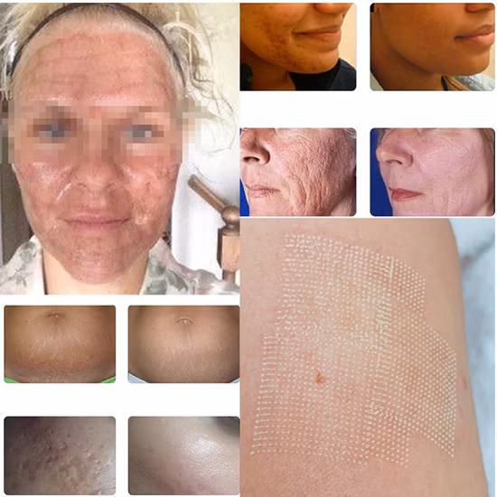 Winkonlaser 70W Fractional CO2 Laser Device for Scar Acne Removal Vaginal Serrage Professional CO2 Fractional Laser Machine